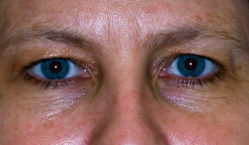 Eyelid Surgery Before & After Gallery - Patient 142403 - Image 1