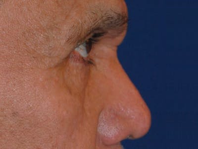 Nasal Fracture Before & After Gallery - Patient 233478 - Image 2