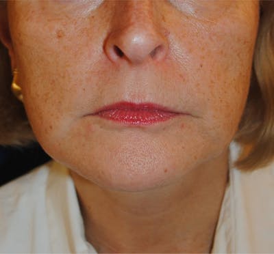 Facelift/Mini Facelift Before & After Gallery - Patient 168974 - Image 2