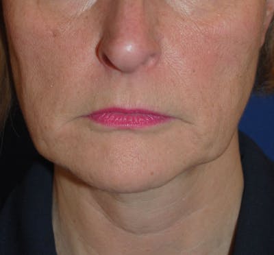 Facelift/Mini Facelift Before & After Gallery - Patient 168974 - Image 1