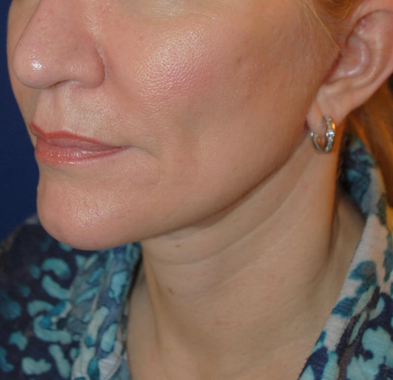 Facelift/Mini Facelift Before & After Gallery - Patient 197414 - Image 2