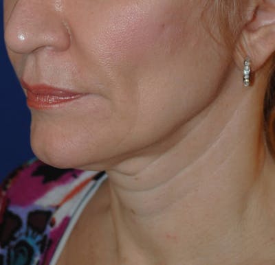 Facelift/Mini Facelift Before & After Gallery - Patient 197414 - Image 1