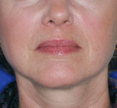 Facelift/Mini Facelift Before & After Gallery - Patient 180629 - Image 2