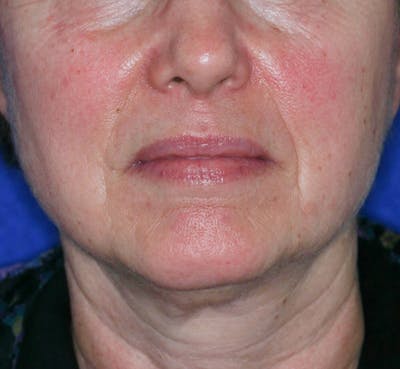Facelift/Mini Facelift Before & After Gallery - Patient 180629 - Image 1