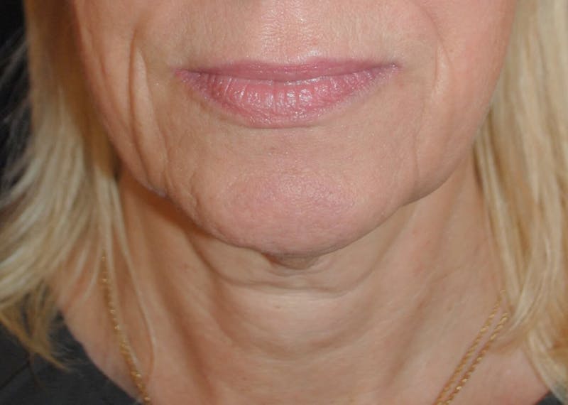 Facelift/Mini Facelift Before & After Gallery - Patient 272316 - Image 1