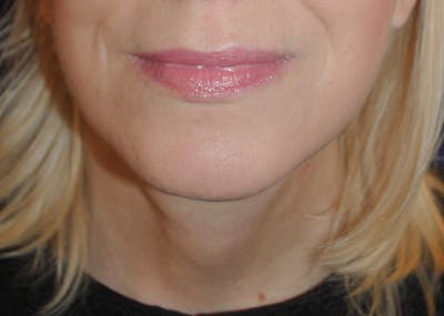 Facelift/Mini Facelift Before & After Gallery - Patient 272316 - Image 2