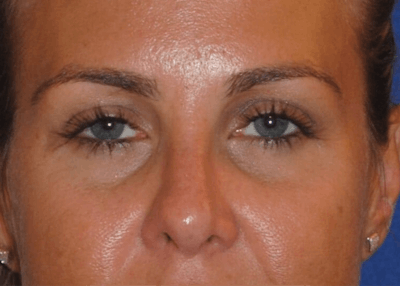Rhinoplasty Before & After Gallery - Patient 250167 - Image 2