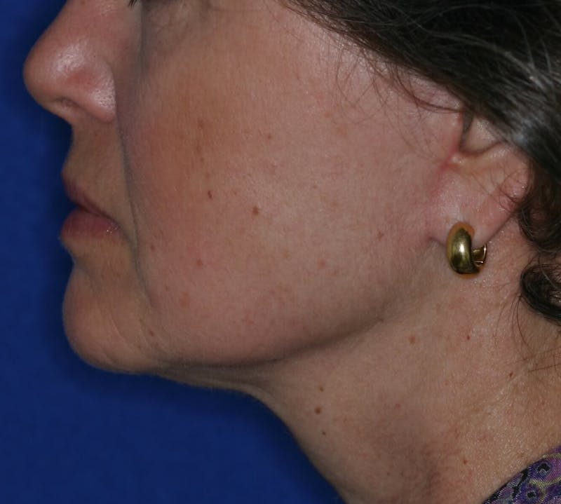 Facelift/Mini Facelift Before & After Gallery - Patient 180629 - Image 4