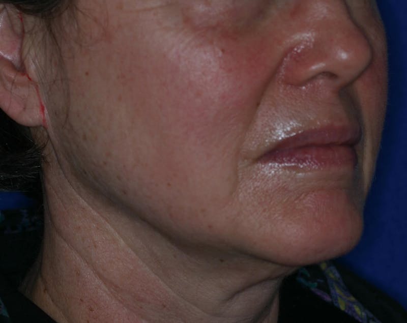 Facelift/Mini Facelift Before & After Gallery - Patient 180629 - Image 5
