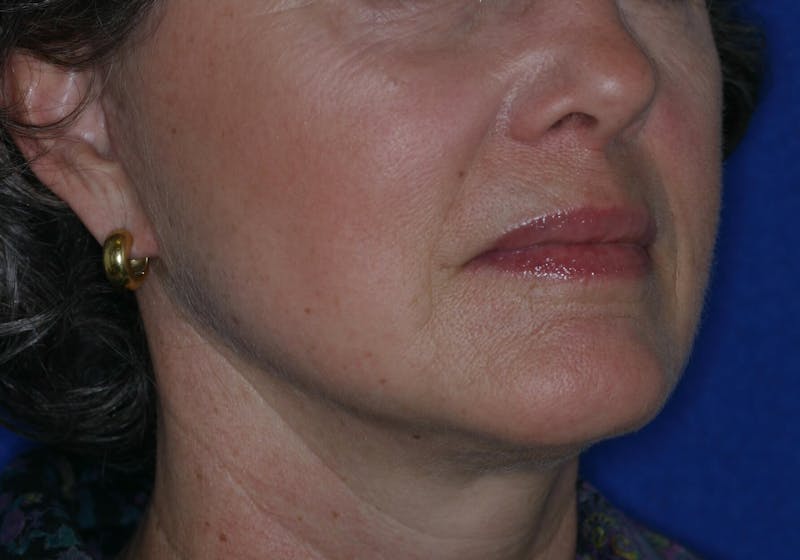 Facelift/Mini Facelift Before & After Gallery - Patient 180629 - Image 6