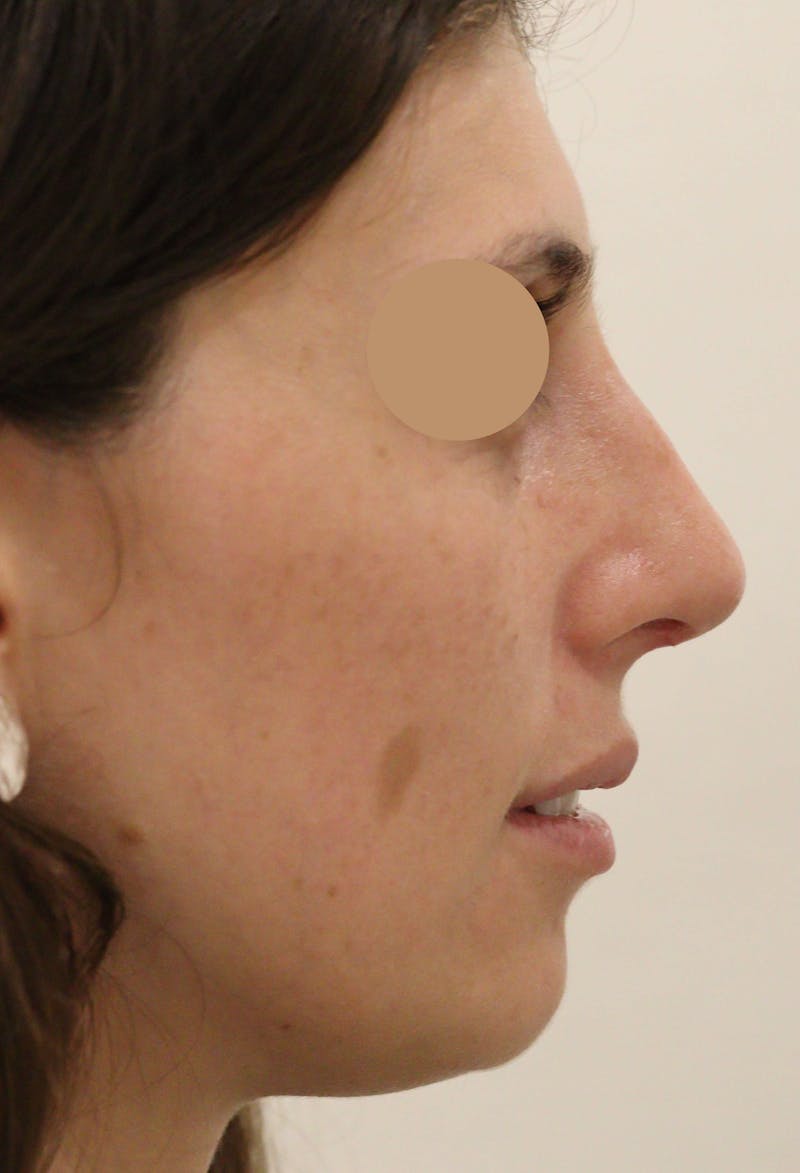 Nasal Valve Collapse Treatment Before & After Gallery - Patient 300613 - Image 2