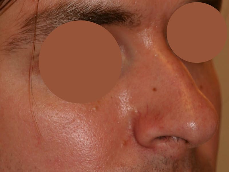 Nasal Valve Collapse Treatment Before & After Gallery - Patient 391183 - Image 3