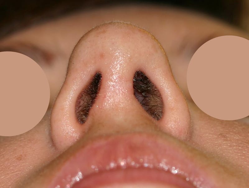 Nasal Valve Collapse Treatment Before & After Gallery - Patient 158178 - Image 2