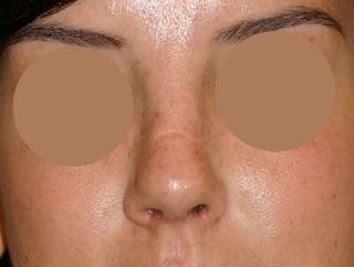 Nasal Valve Collapse Treatment Before & After Gallery - Patient 158178 - Image 4