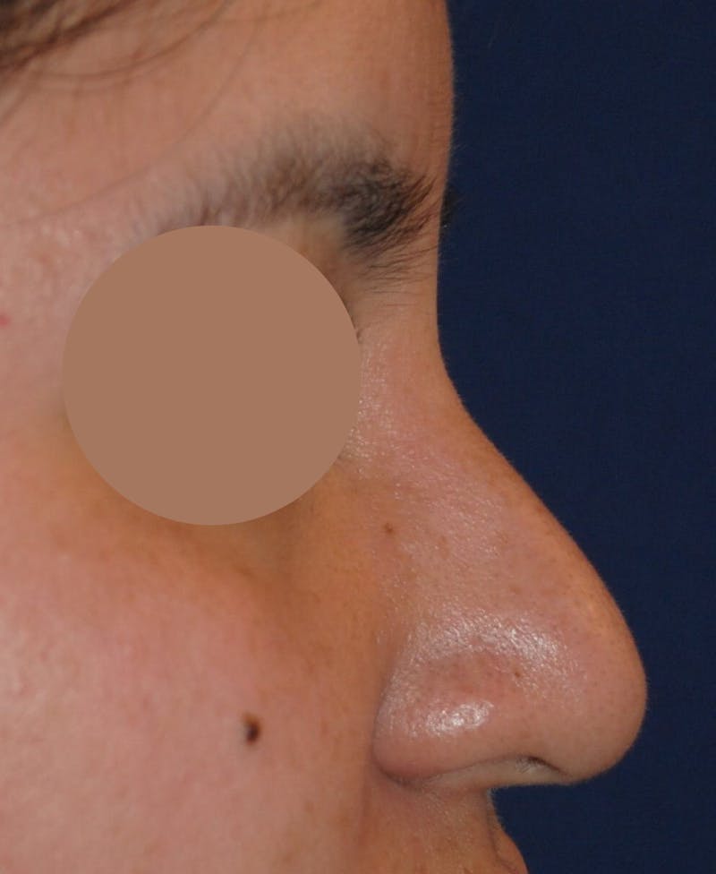 Nasal Valve Collapse Treatment Before & After Gallery - Patient 200263 - Image 3