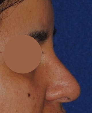 Nasal Valve Collapse Treatment Before & After Gallery - Patient 200263 - Image 4