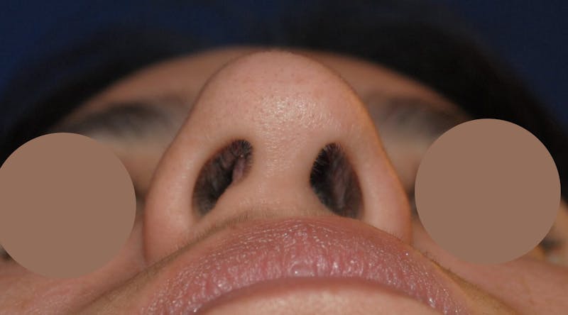 Nasal Valve Collapse Treatment Before & After Gallery - Patient 200263 - Image 5