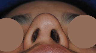 Nasal Valve Collapse Treatment Before & After Gallery - Patient 200263 - Image 6