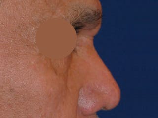Nasal Fracture Before & After Gallery - Patient 233478 - Image 2