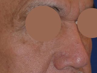 Nasal Fracture Before & After Gallery - Patient 233478 - Image 4