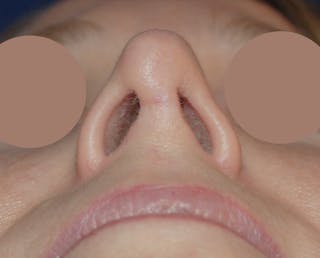 Septal Perforation Repair Before & After Gallery - Patient 373153 - Image 2