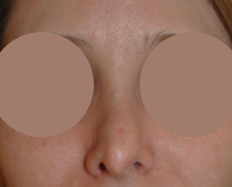 Septal Perforation Repair Before & After Gallery - Patient 373153 - Image 3