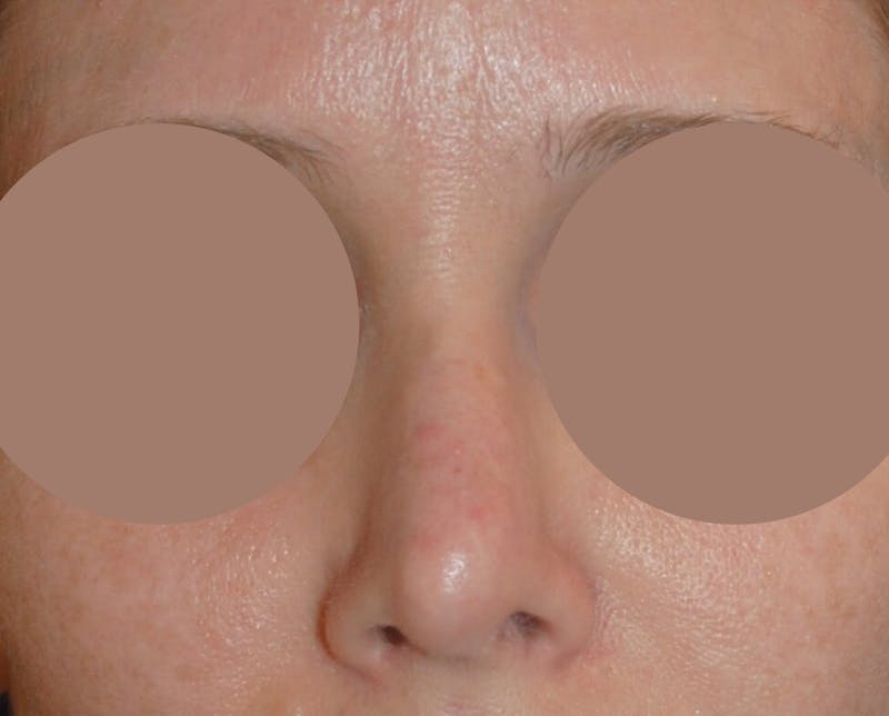 Septal Perforation Repair Before & After Gallery - Patient 373153 - Image 4
