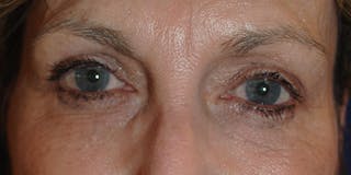 Eyelid Surgery Before & After Gallery - Patient 265850 - Image 2