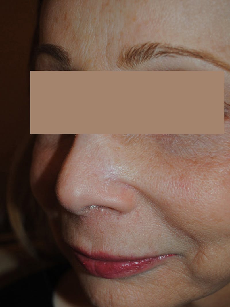 Mohs Surgery Before & After Gallery - Patient 410423 - Image 2