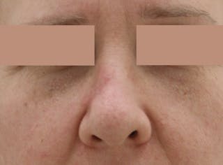 Mohs Surgery Before & After Gallery - Patient 298013 - Image 2