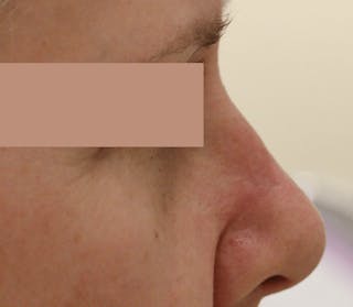 Mohs Surgery Before & After Gallery - Patient 298013 - Image 4