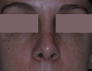 Nasal Fracture Before & After Gallery - Patient 331178 - Image 2
