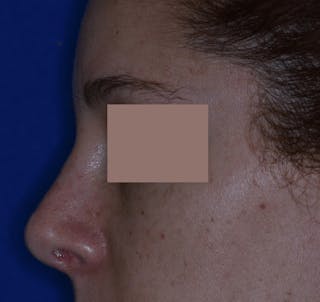 Nasal Fracture Before & After Gallery - Patient 331178 - Image 4