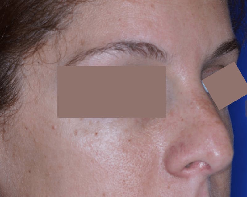 Nasal Fracture Before & After Gallery - Patient 331178 - Image 5
