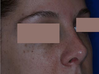 Nasal Fracture Before & After Gallery - Patient 331178 - Image 6