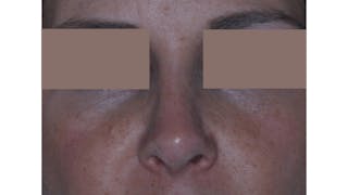 Revision Rhinoplasty Before & After Gallery - Patient 219587 - Image 2