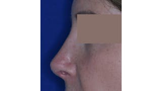 Revision Rhinoplasty Before & After Gallery - Patient 219587 - Image 4