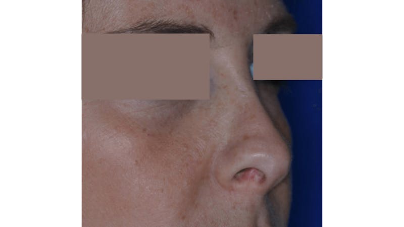 Revision Rhinoplasty Before & After Gallery - Patient 219587 - Image 5