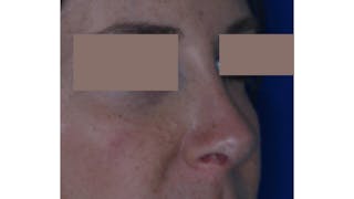 Revision Rhinoplasty Before & After Gallery - Patient 219587 - Image 6