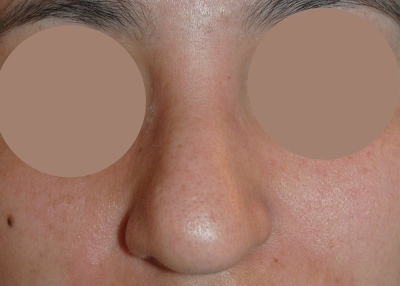 Nasal Valve Collapse Treatment Before & After Gallery - Patient 200263 - Image 1