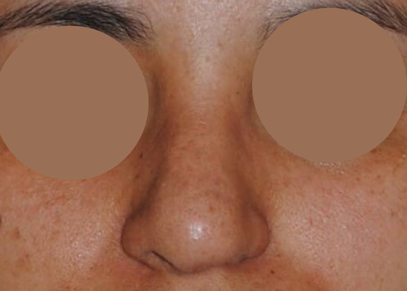 Nasal Valve Collapse Treatment Before & After Gallery - Patient 200263 - Image 2