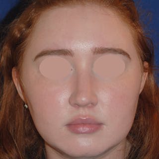 Deviated Septum Repair Before & After Gallery - Patient 405991 - Image 2