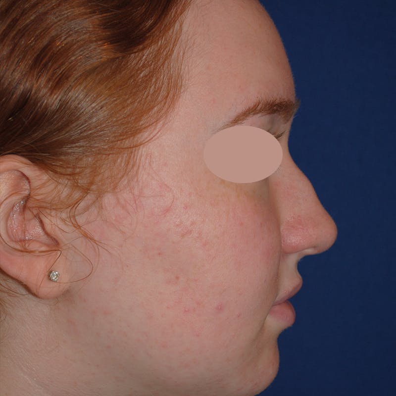 Deviated Septum Repair Before & After Gallery - Patient 405991 - Image 3