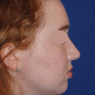 Deviated Septum Repair Before & After Gallery - Patient 405991 - Image 4