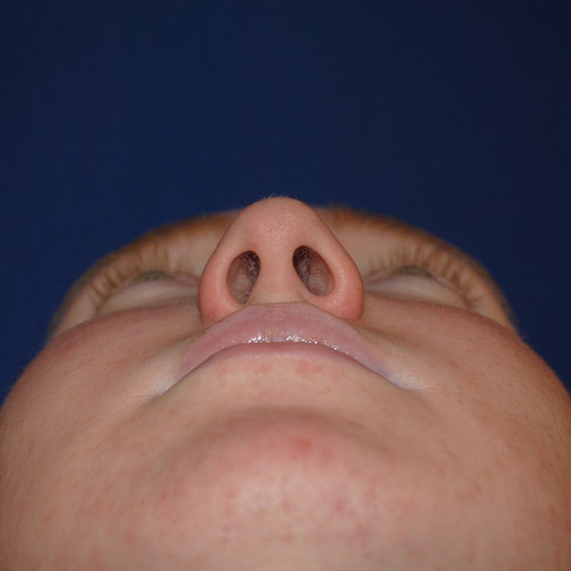 Deviated Septum Repair Before & After Gallery - Patient 405991 - Image 5