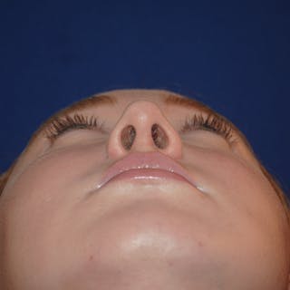 Deviated Septum Repair Before & After Gallery - Patient 405991 - Image 6