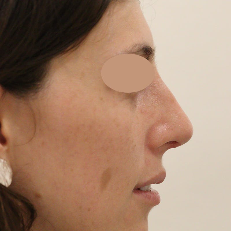 Deviated Septum Repair Before & After Gallery - Patient 123586 - Image 2