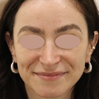 Septal Perforation Repair Before & After Gallery - Patient 226475 - Image 2