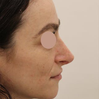 Septal Perforation Repair Before & After Gallery - Patient 226475 - Image 4