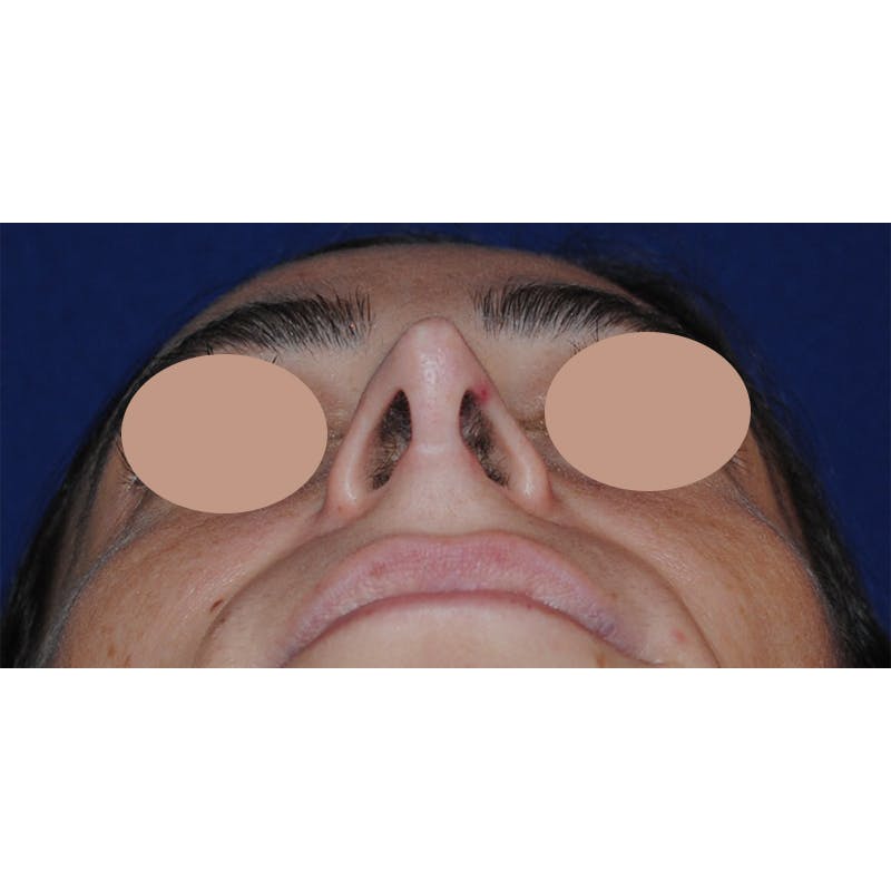 Septal Perforation Repair Before & After Gallery - Patient 226475 - Image 5